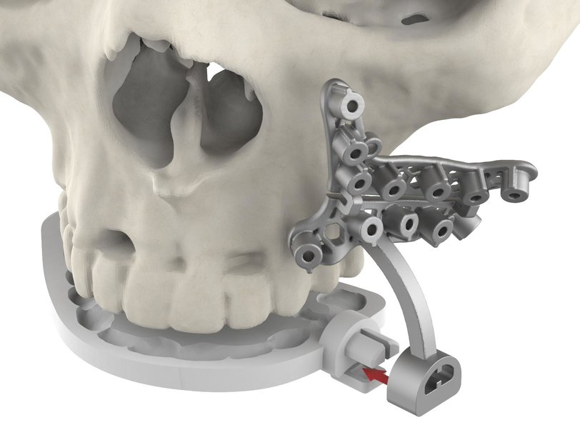 3D Systems lance les guides hybrides VSP® : une solution innovante basée sur l'occlusion et personnalisée en fonction du patient pour la chirurgie maxillo-faciale